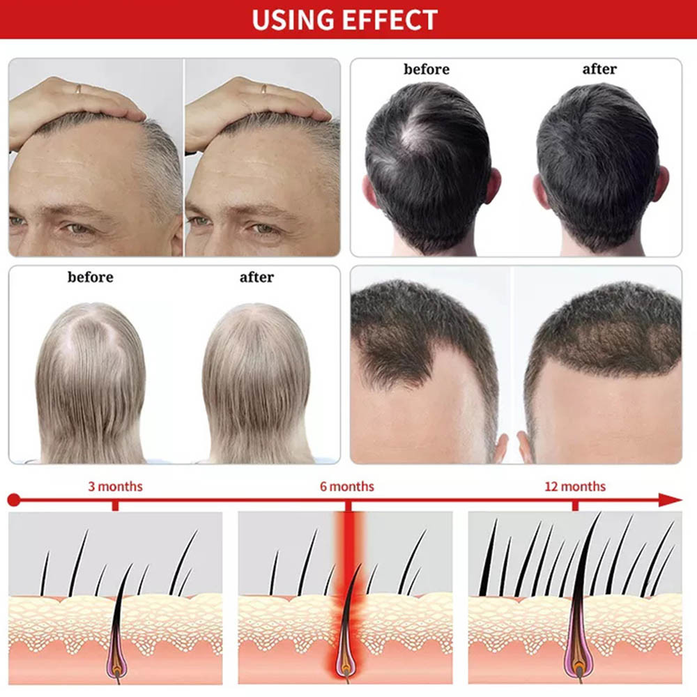 Multifunctional Red Light Therapy Helmet For Hair Growth / Pain Relief