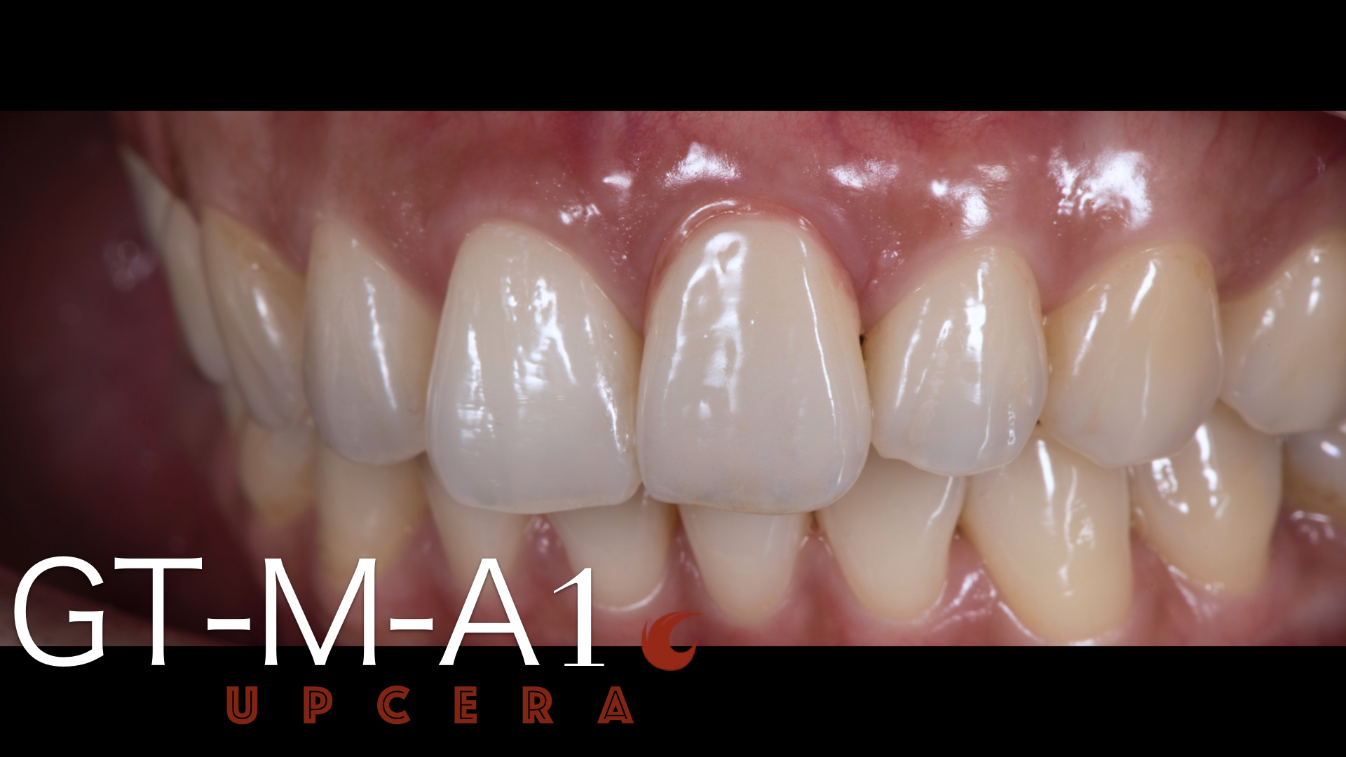 Translucent 600MPa 2.8g/cm3 Dental Zirconia Blocks Anterior Solid