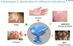 XeCl 308NM Excimer System Light Wavelength For Treating Skin Vitiligo Psoriasis
