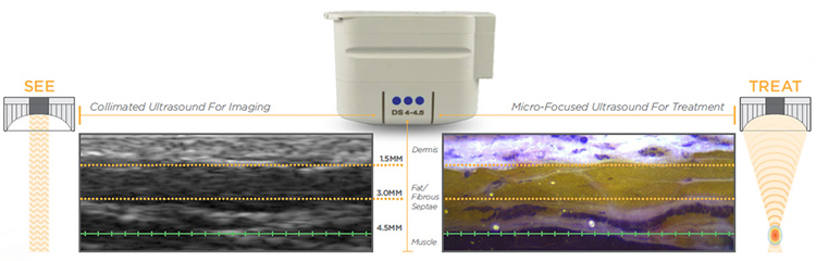Non-surgical face lift equipment Types Of Heads 1.5mm / 3.0mm / 4.5mm180w power screen size 15inch