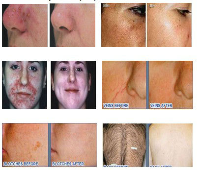 diode laser for hair removal 808nm beauty machine depilight