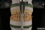High Aesthetics Porcelain Layered Dental Zirconia For Implant Restorations