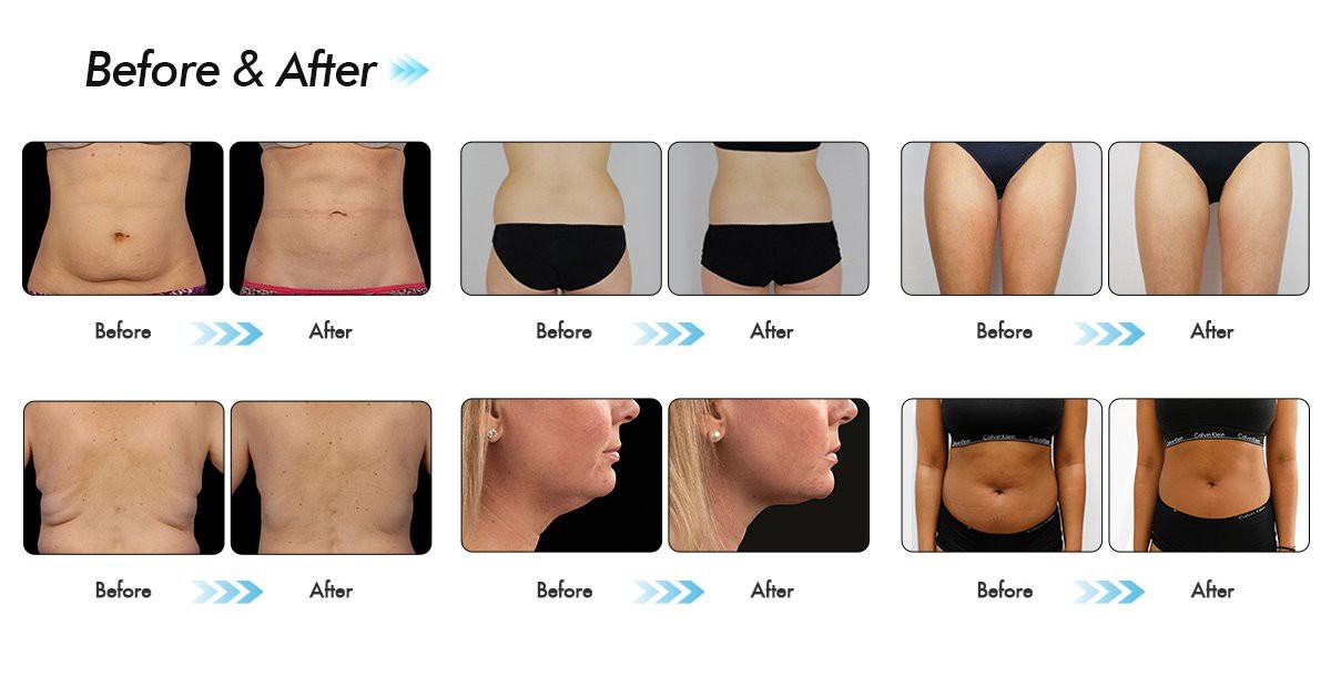 cryolipolysis body slimming machine
