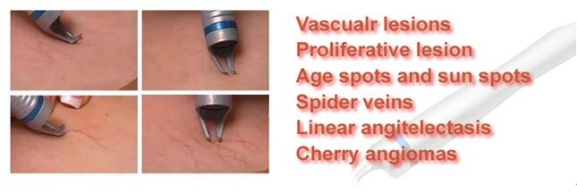 Vein Vascular removal equipment 980nm diode laser vascular removal machine