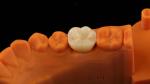 High Aesthetic Full Contour Zirconia Crown with Metal Post Core 5 Years
