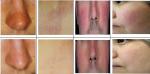 blood vessel removal vascular lesion spider vein treatment machine with high