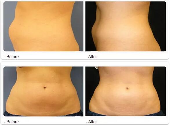 High Power Ultrasonic Cavitation Slimming Machine RF Vacuum Machine