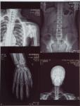 High-clarity Medical X Ray Film FUJI DIHT 14*17in Laser Dry Imaging Film