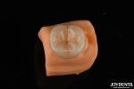0.5mm Stain Resistant Emax Inlay Onlay Accurate Fit For Dental Restorations