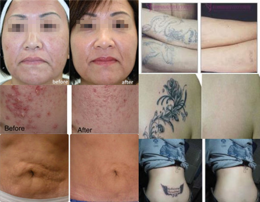 portable tattoo removal machines for sale