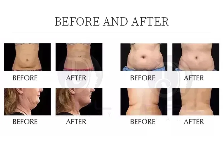 Multifunction Vertical Wrinkle Removal body Contuoring 80K Vacuum Cavitation System Slimming Machine As85