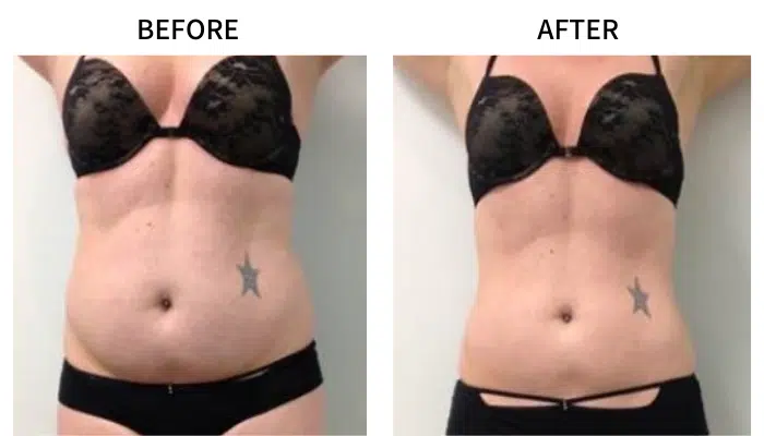 Emerald Laser Fat Reduction Machine With 5332nm 10pcs Diodo