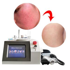 Wholesale 6 In 1 Spider Vein Laser Machine , 980nm Face Vascular Treatment Varicose Veins Machine from china suppliers