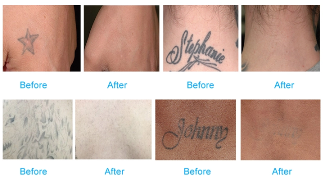 Laser Picosecond Nd Yag Laser 755 Tattoo Removal Machine laser beauty Equipment Q-switched Pigment Removal fractional