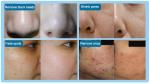 4 Tips Dermabrasion Diamond Peel Hydro Facial Machines