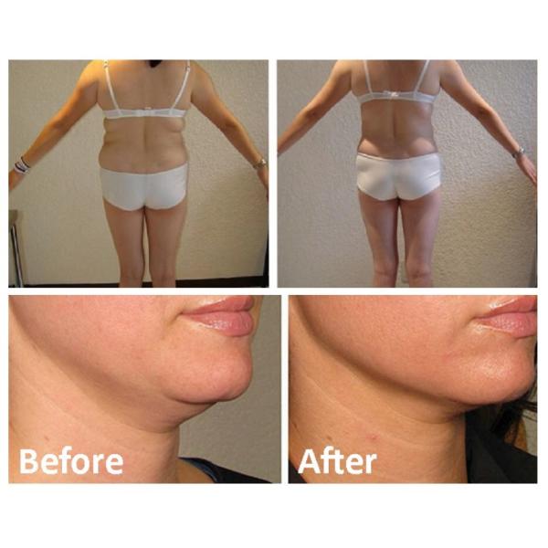 Skinject Fat Lipolysis Injection To Lose Weight Fast