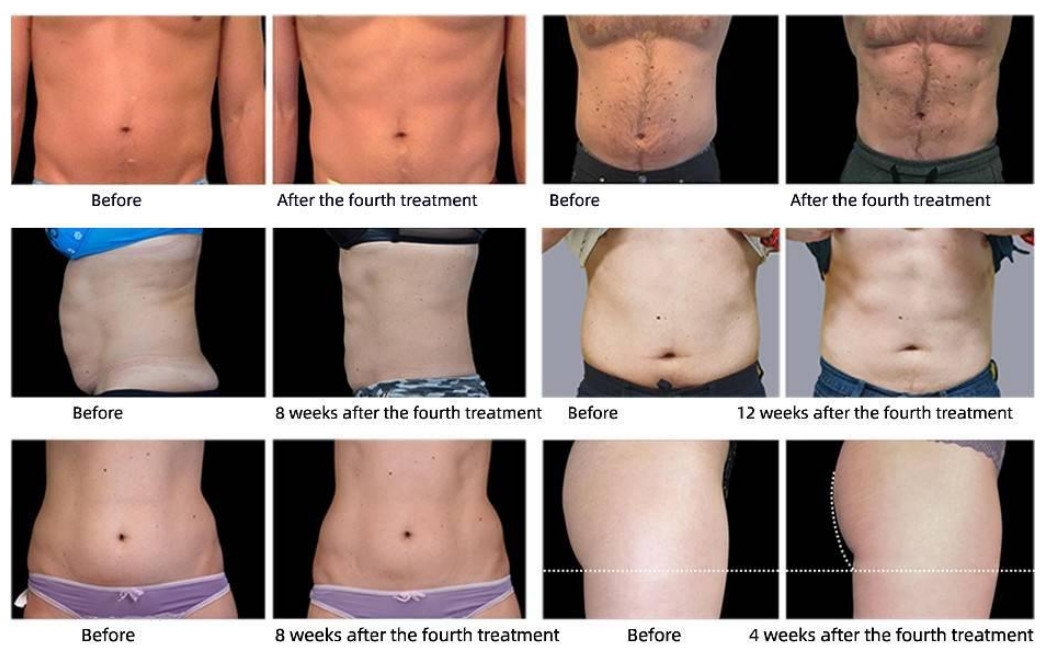 Electromagnetic Radio Frequency Fat Reduction Machine Cellulite Removal
