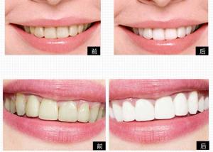 Wholesale Private Logo Personal Care Products Tooth Bleaching System For Home Teeth Whitening from china suppliers