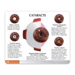Human Eyeball Cataract Anatomy Medical Science Human Eye Anatomy Model