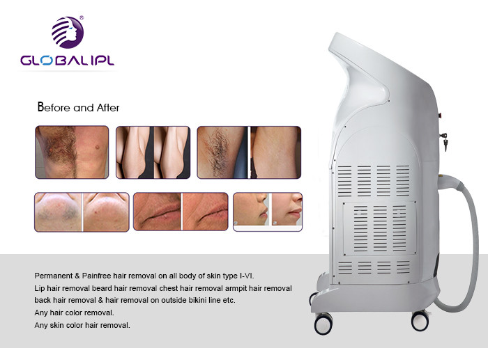 Painless Diode Laser Hair Removal Machine 5 - 400ms Pulse Width Long Lifetime