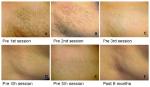 2000W 12*20mm spot size 808nm diode laser hair removal machine For clinic / Spa