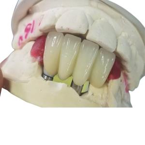 Wholesale Strong Ti Base Milling Dental Implant Crowns Tooth Supported Bridge from china suppliers