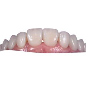 Wholesale 0.3MM Whitening Ceramic Dental Crown To Replace Unhealthy Teeth from china suppliers