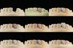 Ceramic For Natural Aesthetics Dental Veneers Stain Resistance Maintains