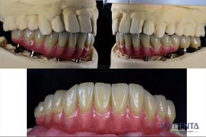 Wholesale Dental Reconstruction Multiple Teeth Implant Titanium Prosthetic Connection Internal from china suppliers