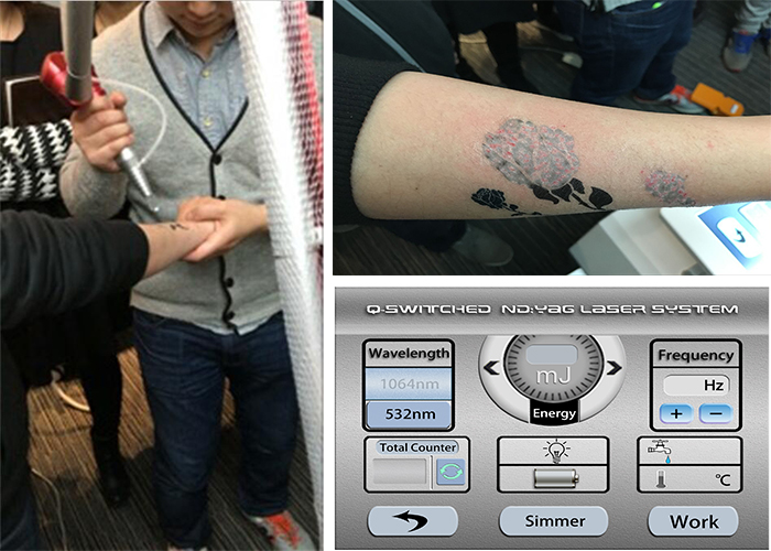 Professional q switched nd yag laser/painless 1064/532nm laser tattoo removal machine