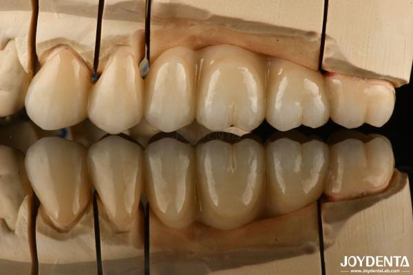 Natural Looking Multilayer Full Zirconia For Dental Restorations Ultra