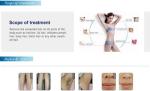 30%Promo TUV Medical CE Germany bars 808nm diode laser hair removal / 808 diode