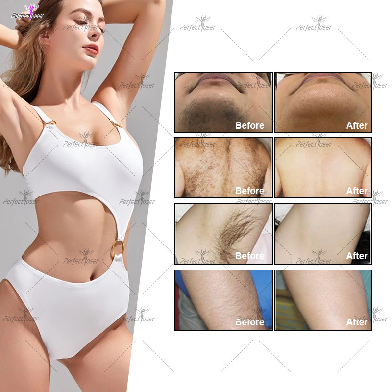 Portable Flawless 808nm Diode Laser Hair Removal Machine 3 Wavelength
