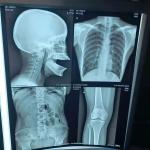 200±5μM Thickness Medical X Ray Film For Diagnostic High Density