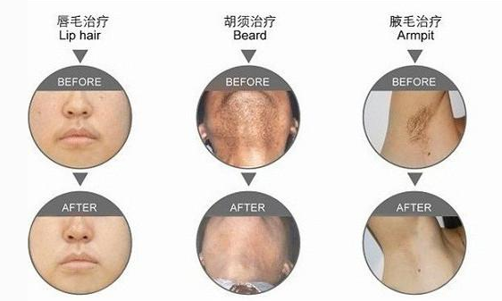 Effective SHR Hair Removal Machine Multifunctional Strong Ipl Beauty Equipment