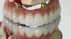Wholesale Dental All On X Implant PFM Crown Titanium Fixed Hybrid Denture from china suppliers