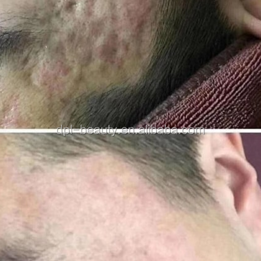 Golden Nano Fractional RF Microneedling Devices For Home Acne Removal