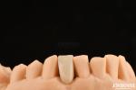Ideal Matching Clinical Bonding Maryland Dental For Oral Clinical Repair Work