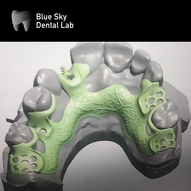 Adjustable Denture Metal Framework Resin Teeth Rpd Metal Framework