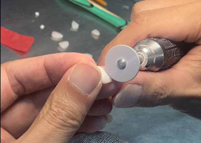 IPS emax Press Porcelain Veneers Achieve a Natural and Radiant Smile