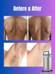 755 808 1064nm OEM Diode Laser Hair Removal Device for Ozero Khanka Pioneer