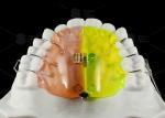 Orthodontic Fan Shaped Expander Provides Posterior Crossbite Free Section