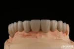 PFM Porcelain Fused to Metal Crowns and Bridges Seamless Bonding for Natural