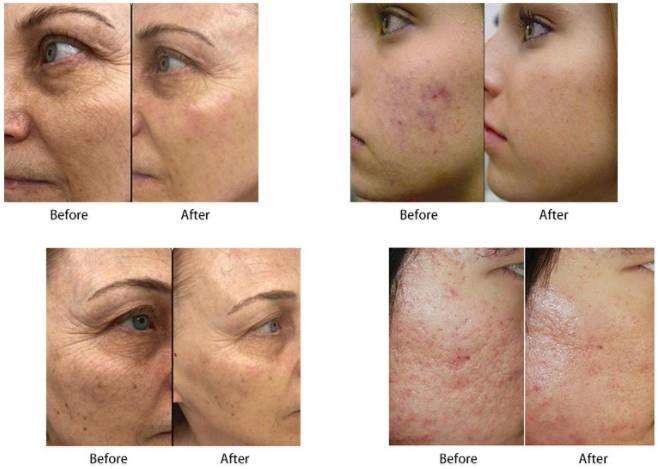 Salon 50W Radio Frequency Microneedling Machine Skin Tightening