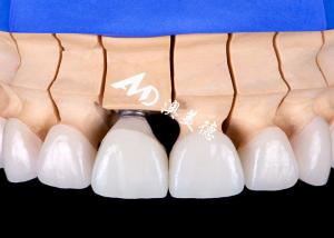 Wholesale Functional Aesthetic Dental Implant Crown Bridge – Precision and Durability from china suppliers