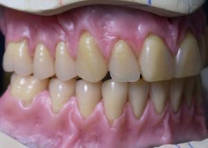 Wholesale Hot Cured Full Arch Removable Acrylic Full Denture from china suppliers