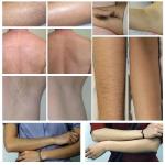 Factory Price Portable Hair Removal Diode Laser 808nm 755 808 1064nm 3