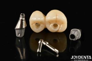 Wholesale Customizable Porcelain Dental Implant Supported Bridge And Crown For Exceptional Aesthetics from china suppliers