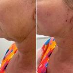 980nm 1470nm Endolaser Face Lift Lipolysis Machine Diode Laser Fat Removal