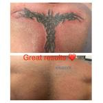 50kg Q Switched Nd YAG Tattoo Removal Machine 100-2000J Picolaser Machine